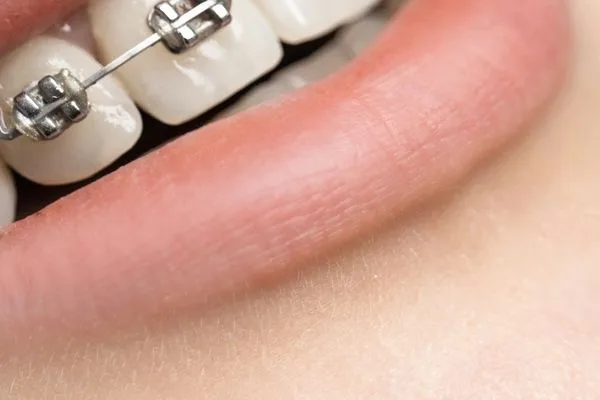 Illustrative draft image: Orthodontic braces treatment