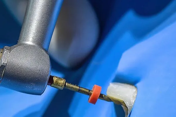 Illustrative draft image: Root canal treatment procedure